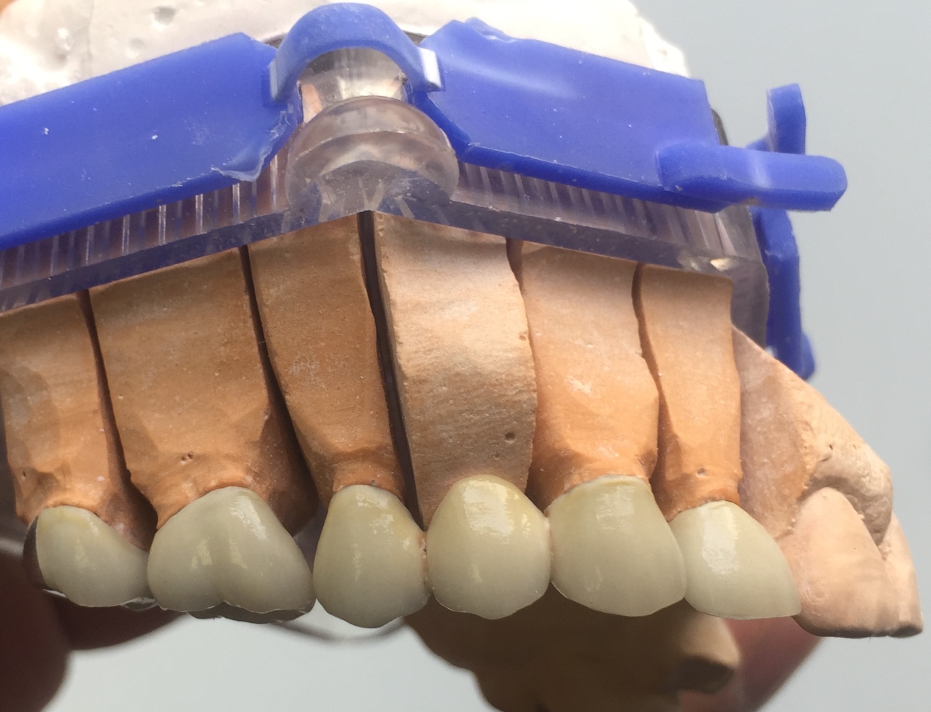 Crowns and Bridges Clinical Case Church Street Dental