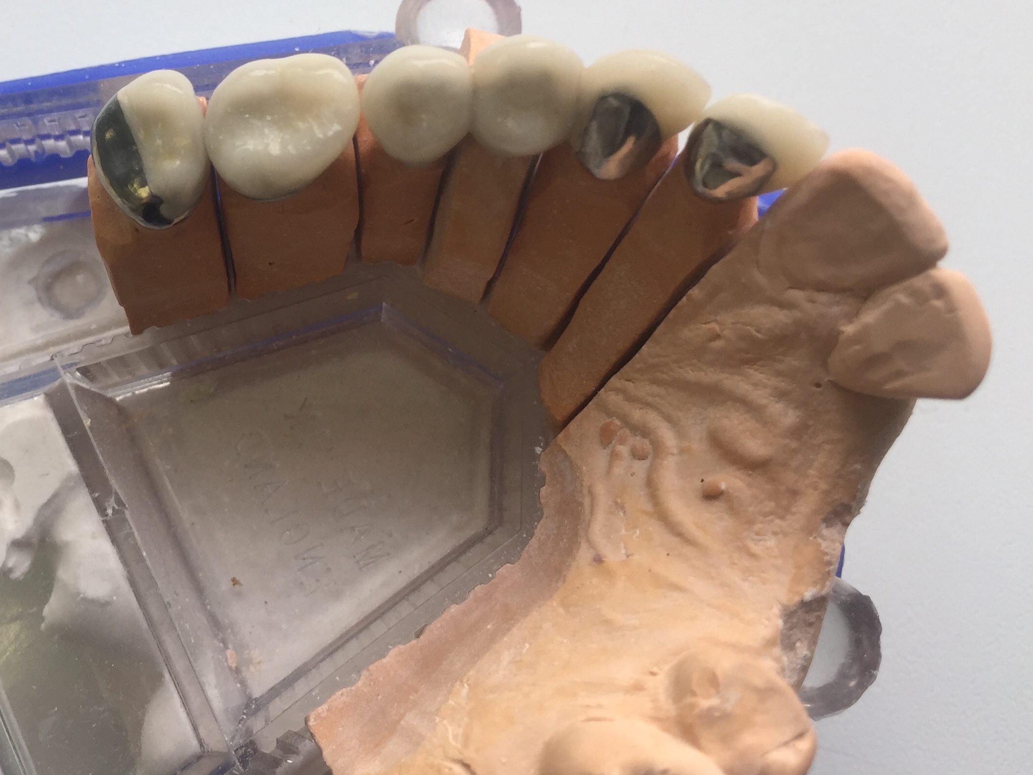 After: Case 6: Ceramic Crowns & Bridgework