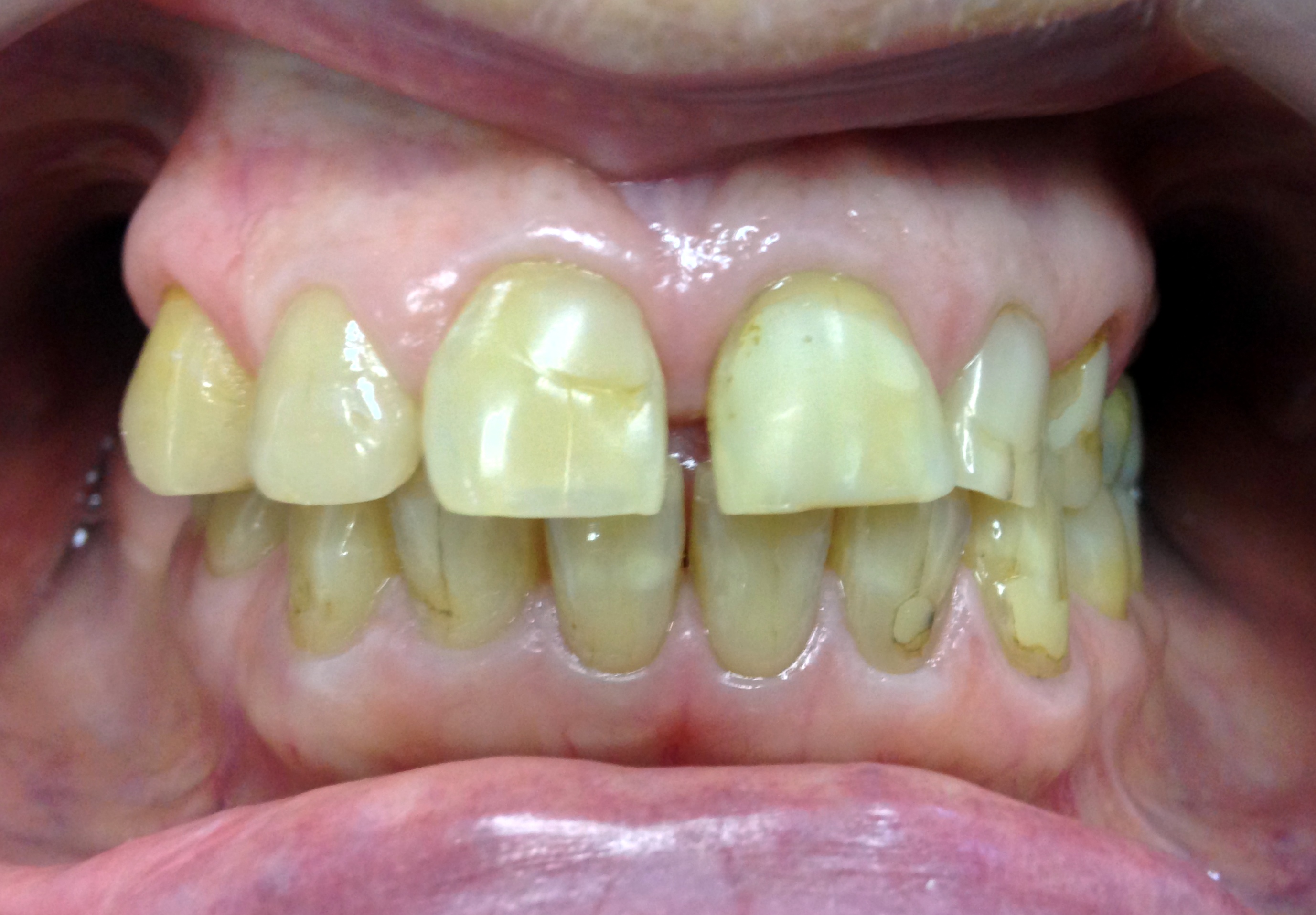 Before: Case 1: Full Smile Restoration