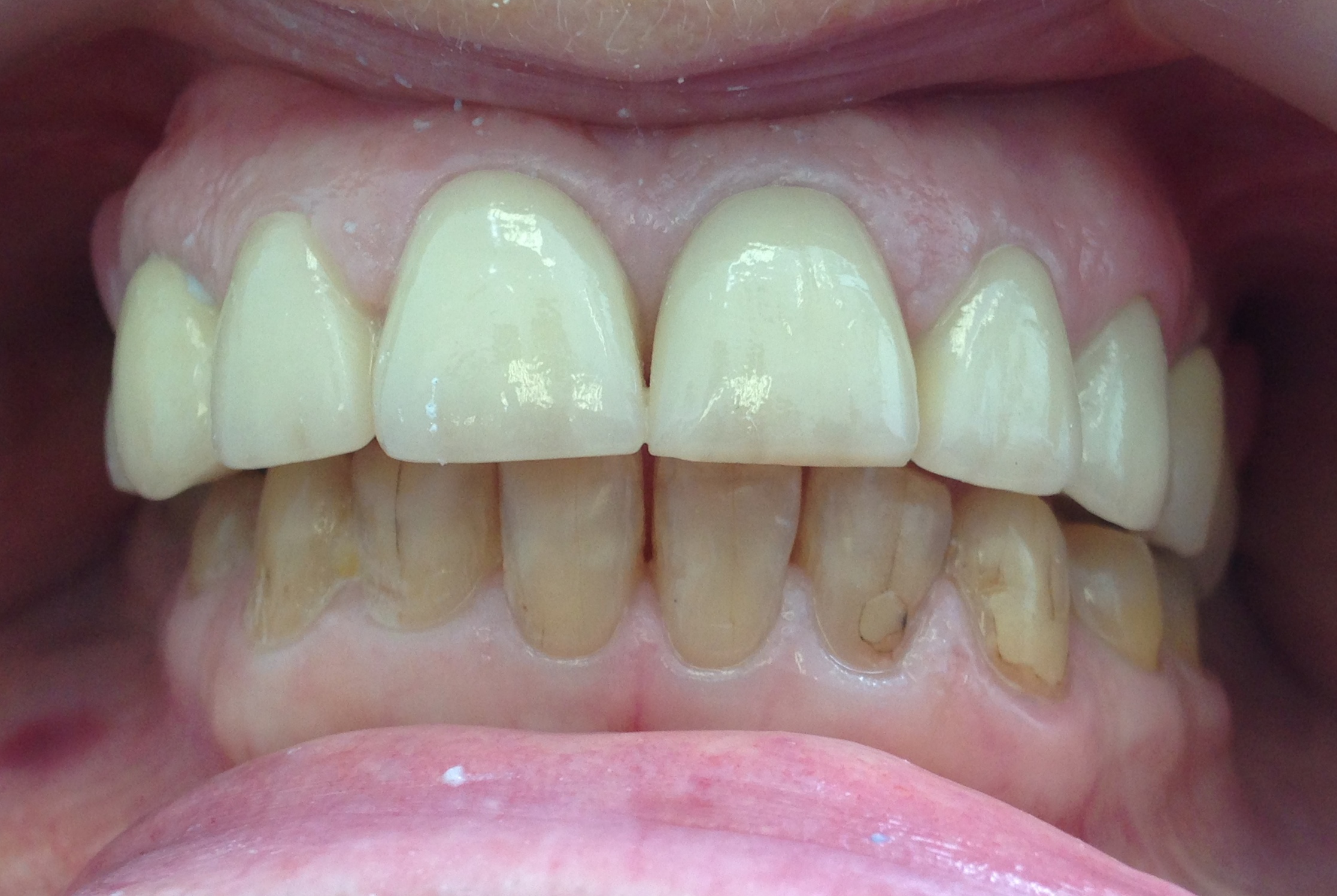 After: Case 1: Full Smile Restoration