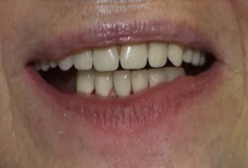 After: Case 2: Anterior Alignment & Bonding