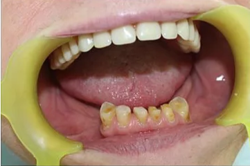 Before: Case 2: Anterior Alignment & Bonding