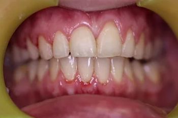 After Dermal Filler Lip Enhancement