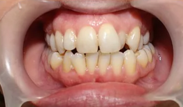 Before: Case 3: Aesthetic Tooth Rejuvenation