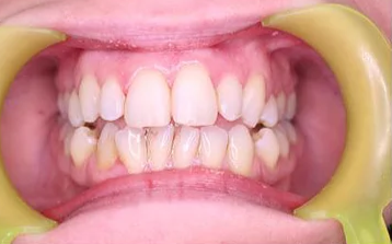 After: Case 3: Aesthetic Tooth Rejuvenation