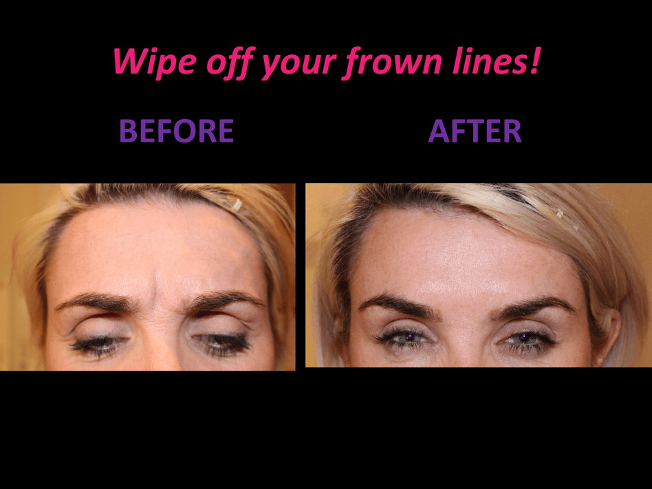 After Anti-Wrinkle Treatment