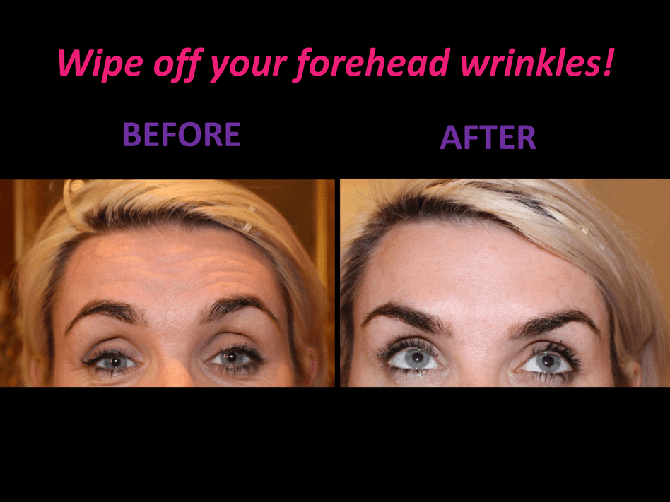 Before Anti-Wrinkle Treatment