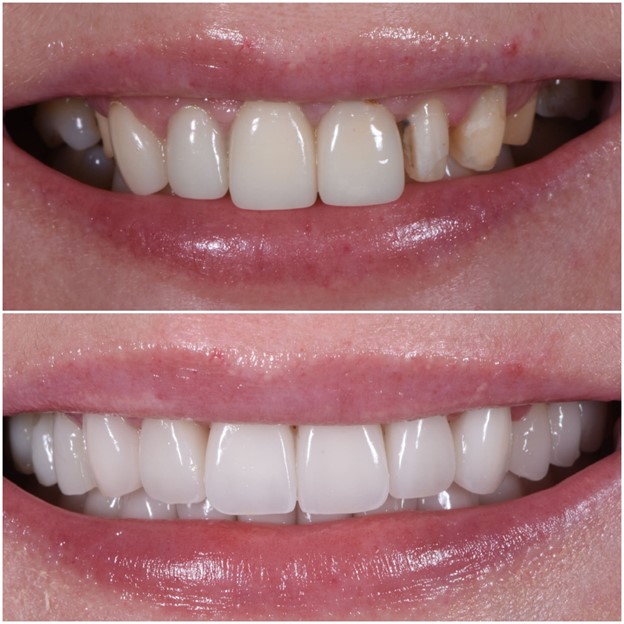Composite Bonding Before and After at Church Street Dental