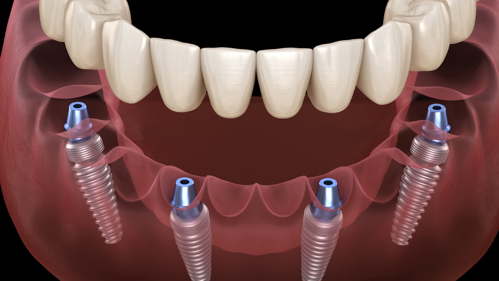 Dental Implants and Full Arch Replacement